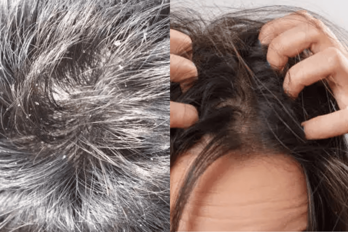 Winter Dandruff Remedies: सर्दियों में डैंड्रफ से है परेशान, इन घरेलू नुस्खों में है इस समस्या का समाधान