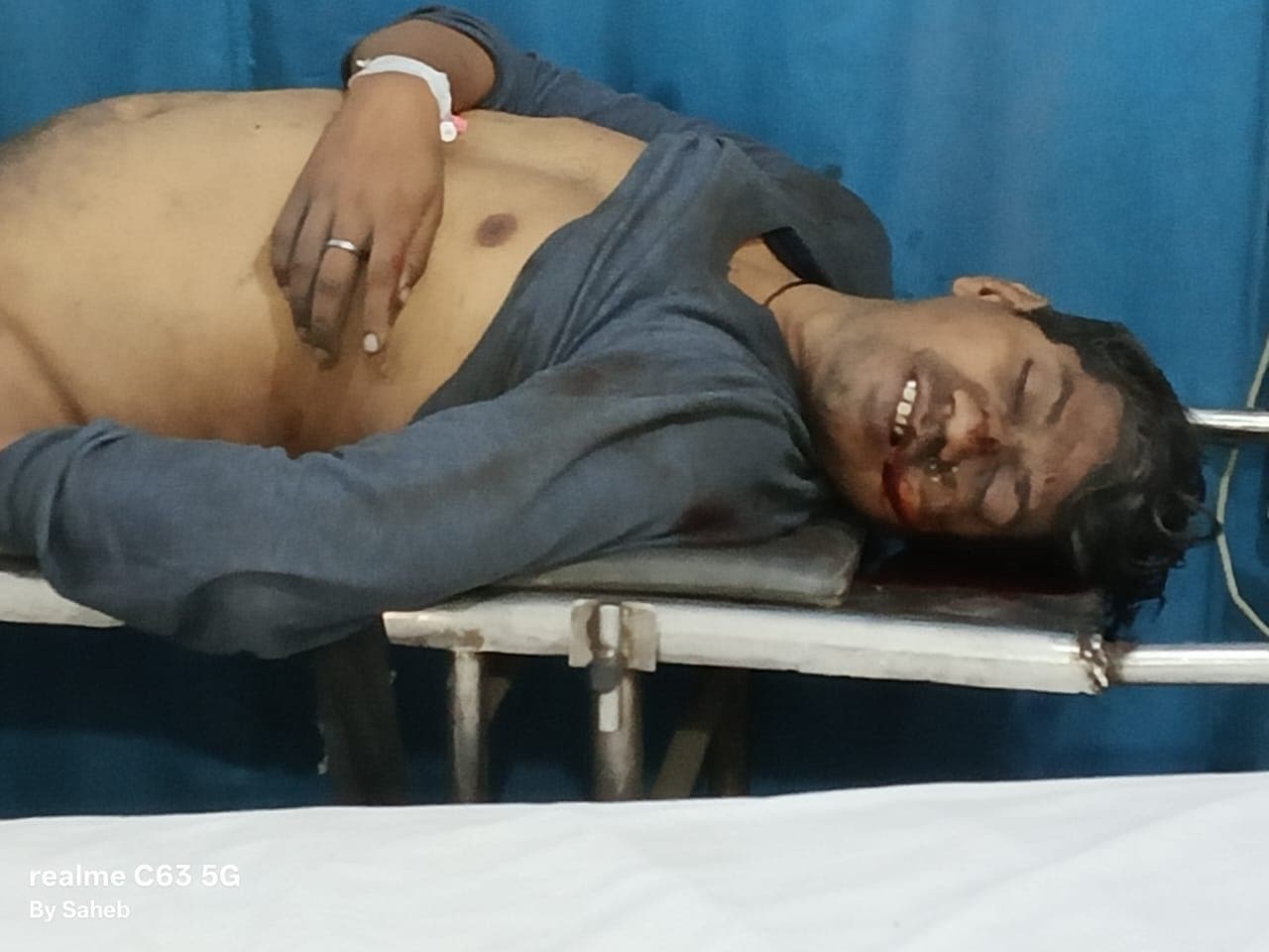 Bokaro News : एएडीओसीएम परियोजना में ओवरबर्डन धंसा, ठेका मजदूर की दबकर मौत