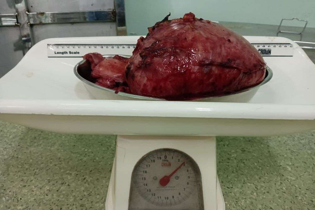 पटना : 48 साल की महिला के गर्भाशय से निकाला 3 किलो का फाइब्रॉयड, फोर्ड हॉस्पिटल के डॉक्टरों ने किया कमाल